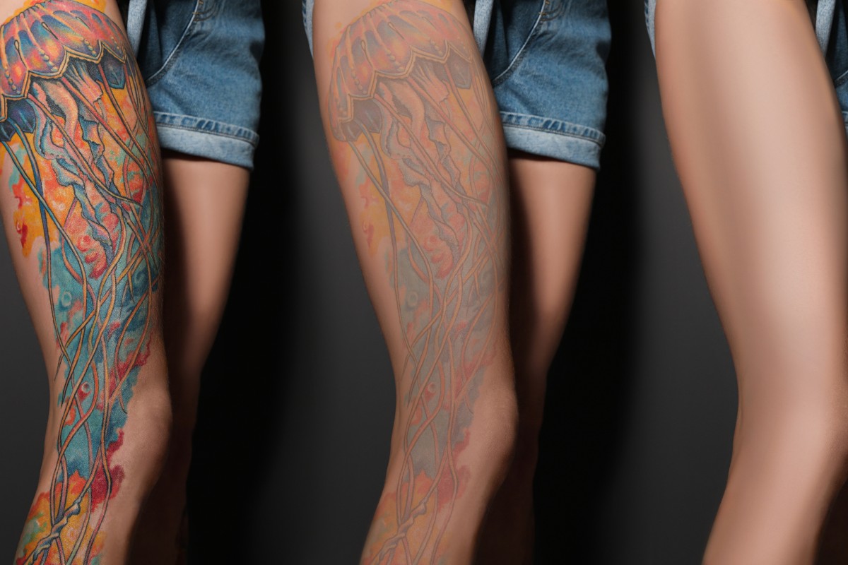 The cost for tattoo removal ranges from $400 to $4000